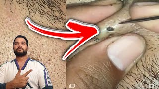 hair ingrown  hair ingrown removal  hair ingrown removal satisfying [upl. by Nirraj944]