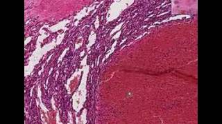 Histopathology Breast soft tissueHemangioma [upl. by Calvo]