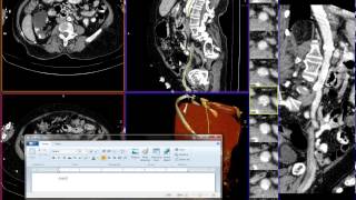 CT SCAN OF AORTA ABDOMINAL IN CASE CALSIFICATION [upl. by Habeh865]