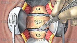 2 Level Cervical Arthrodesis with ProDiscC [upl. by Kathleen]