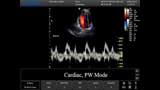 Chison ECO5 Ultrasound Cardiac Imaging  LIVE demo [upl. by Leland305]