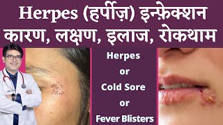 Herpes Infection Of Skin  हर्पीज़ के कारण लक्षण इलाज  Herpes Symptoms Causes Treatment  Hindi [upl. by Alethia]