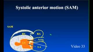 SAM  Systolic Anterior Motion in Feline Cardiomyopathy [upl. by Mcnelly975]