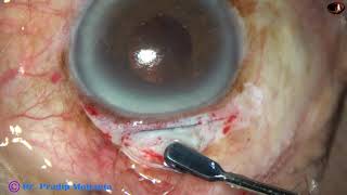 ICCE Intracapsular Cataract Extraction IRIS CLAW IOL implantation amp Ant Vitrectomy  P Mohanta [upl. by Orlan500]