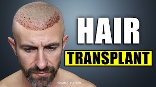 I Went to Bosley for a Hair Transplant [upl. by Hahn]