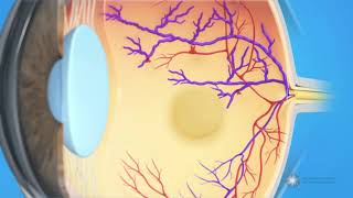 What is branch retinal vein occlusion BRVO [upl. by Anrehs450]