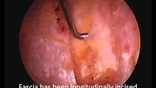 Arthroscopic hip bursectomy  Narrated surgical video [upl. by Elocan891]