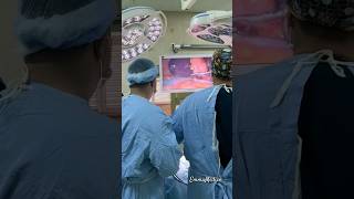 Laparoscopic cholecystectomy a minimally invasive surgery procedure used to remove the gallbladder [upl. by Yssis]