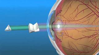 Multifocal Lens IOL [upl. by Towers]