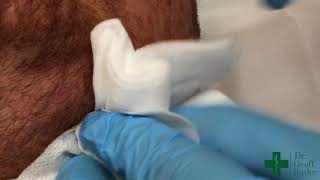 Drainage of an Abscess along the Jaw Line [upl. by Leclair]