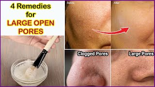 4 Remedies for OPEN PORES  Clogged Pores amp Enlarged Pores ll Get rid of Open Pores Naturally [upl. by Ahtnicaj901]