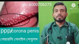 pearly Penile Papules Cause Symptom And Full TreatmentIn Bengali [upl. by Ise]