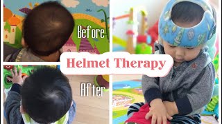 12 Weeks Progress Helmet Therapy For Flat Head SyndromePlagiocephaly [upl. by Selrahc]