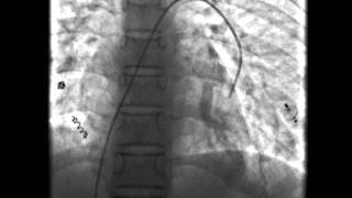 Hereditary Haemorrhagic Telangiectasia [upl. by Eirrahs321]