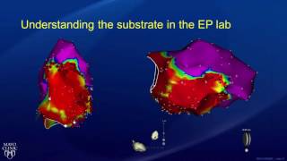 Ablation Treatment for Ventricular Tachycardia  Part 2 [upl. by Tterej]