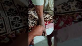 how to check edema pitting edema [upl. by Melli504]