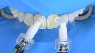 Fluorosis treatment using Icon infiltration step by step [upl. by Ettecul]