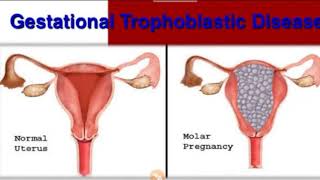 Gestational Trophoblastic Disease in Hindi [upl. by Halstead]