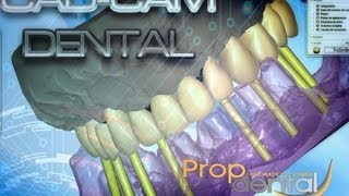 Cad cam dental [upl. by Ikaz]