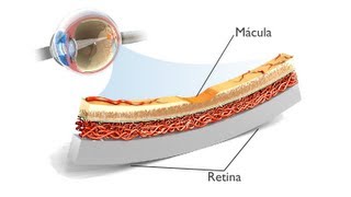 La Degeneración Macular Asociada a la Edad DMAE ANIMACIÓN [upl. by Oberstone103]