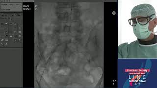 Hatch LC 3  Total Occlusion of Iliac Artery  Leipzig Germany  LINC 2019 [upl. by Airrat]