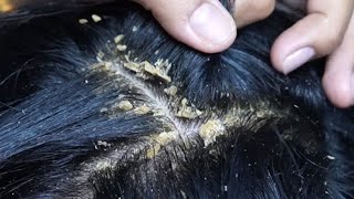 Dandruff scratching removal on head using black combing234 [upl. by Abba692]