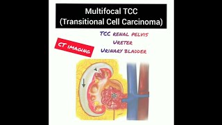 Case report Multicentric Transitional Cell Carcinoma TCC CT AbdomenRadiology 20 [upl. by Ahsihat]