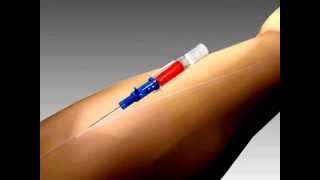 Introcan Safety IV Catheter [upl. by Ydne]