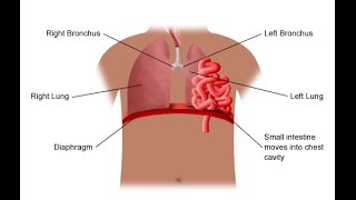 Diaphragmatic Hernia [upl. by Maletta]