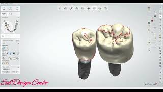 3shape design implant case osstem 3shape 디자인 구치부 간단한 케이스 커스텀 크라운 [upl. by Anitaf890]