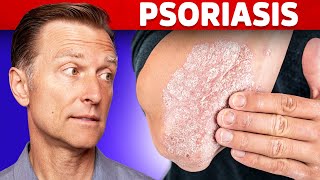 Psoriasis Treatment – The Best 3 Remedies for Psoriasis – DrBerg [upl. by Cob]