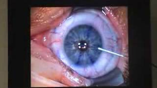 Opération lasik des yeux pour corriger les défauts visuels [upl. by Ledarf]