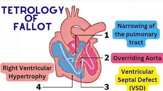 Tetralogy of Fallot The 4 Components Explained [upl. by Warner685]