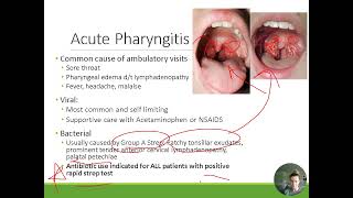 HEENT Treatment of Pharyngitis Rhinosinusitis and Otitis Media [upl. by Ynnig963]