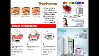 TRACHOMA EYES RELIEF WITH ENAGIC KANGEN WATER [upl. by Tali]