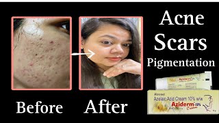 AZIDERM 10 Cream Review  How to apply Aziderm Cream on Face for Acne Scars amp Pigmentation [upl. by Gianina]