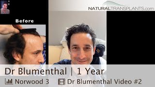 Natural Transplants Doctor Receives Hair Transplant 1 Year Results  Dr Matt Huebner Dr Blumenthal [upl. by Llij]