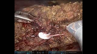 Robotic Left Hepatectomy for a Cystadenoma [upl. by Enra]