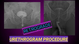 Retrograde Urethrogram Procedure  X ray Urethrogam  Urine Blockage [upl. by Alvarez]