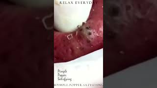 Blackheads new this week tweezers  Top pimple popping 2022 [upl. by Oirretna]