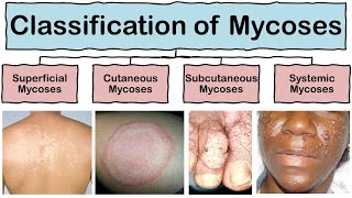 Classification of Mycoses in Hindi  Microbiology  Mycology [upl. by Udall]