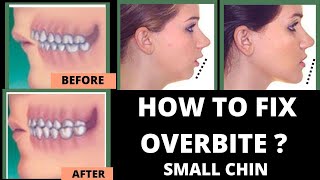 Orthodontic Treatment for Overbite Overjet  Removing Second Molar [upl. by Atiekan]