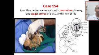 Case 154 meconium aspiration syndrome PPHN  asphyxia  multi organ dysfunction MODair leak pneu [upl. by Euqitsym]