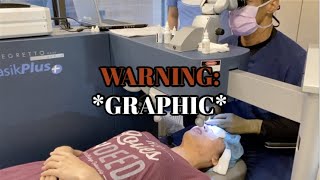 FULL LENGTH Uncut Footage of Lasik Wavefront Surgery with LasikPlus [upl. by Naujid714]