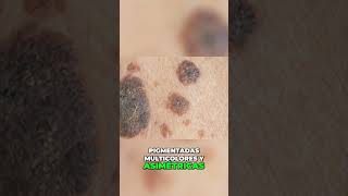 Cuidado con el Melanoma Síntomas y Detección Temprana [upl. by Carlynne]