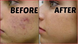 How To Remove Dark Spots Acne Scars Black Spots In Just 3 Days  Get Flawless Glowing Skin [upl. by Lieno897]