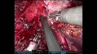 Robotic right hepatectomy for cystic echinococcosis [upl. by Dorelle]