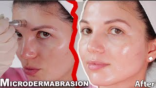 MICRODERMABRASION at home 2021 skin expert FULL procedure and before and after results [upl. by Inesita851]