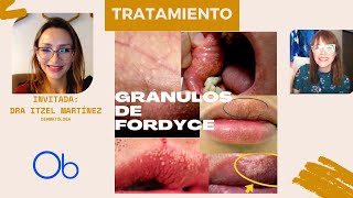 Tratamientos para los GRÁNULOS DE FORDYCE [upl. by Sorvats]