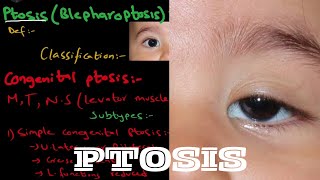 What is Ptosis  Droopy eyelid   it’s types and treatment  detailed explanation [upl. by Nave]